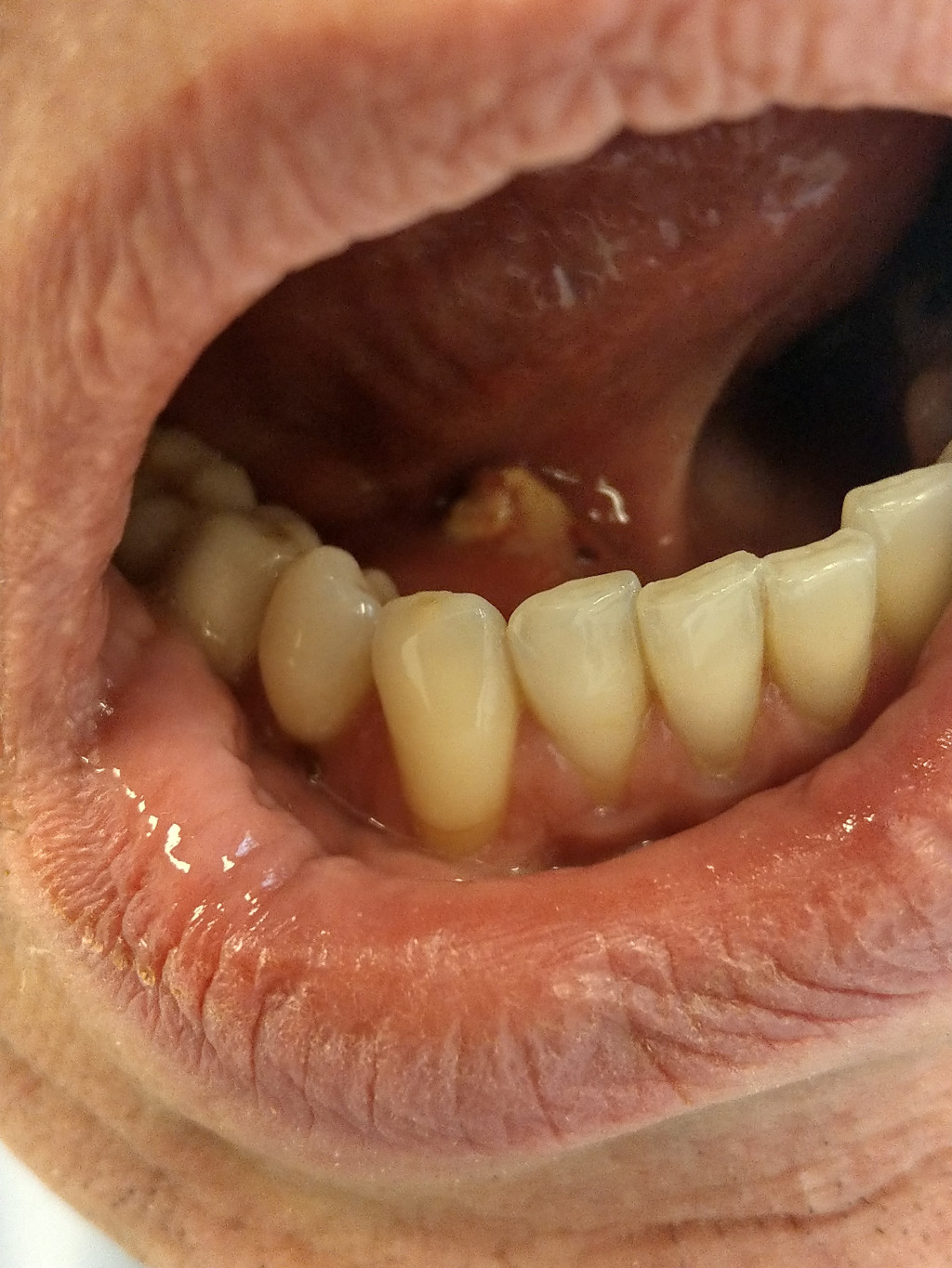 Pijnlijke zwelling onder de tong Huisarts & Wetenschap